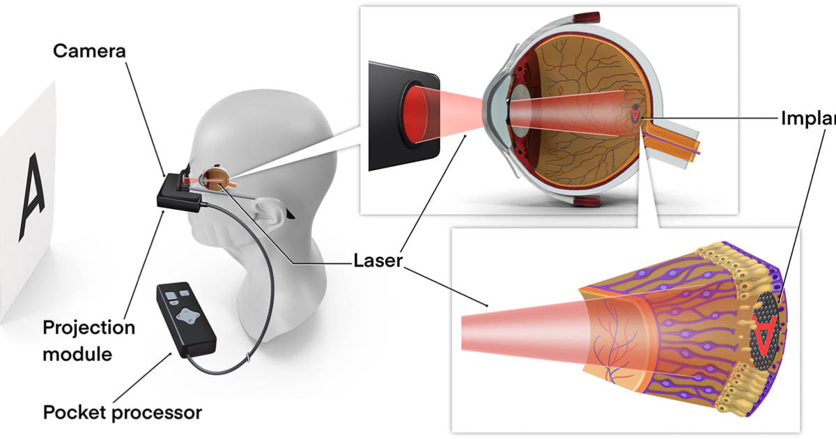 Hightech-Implantat-l-sst-Blinde-wieder-sehen